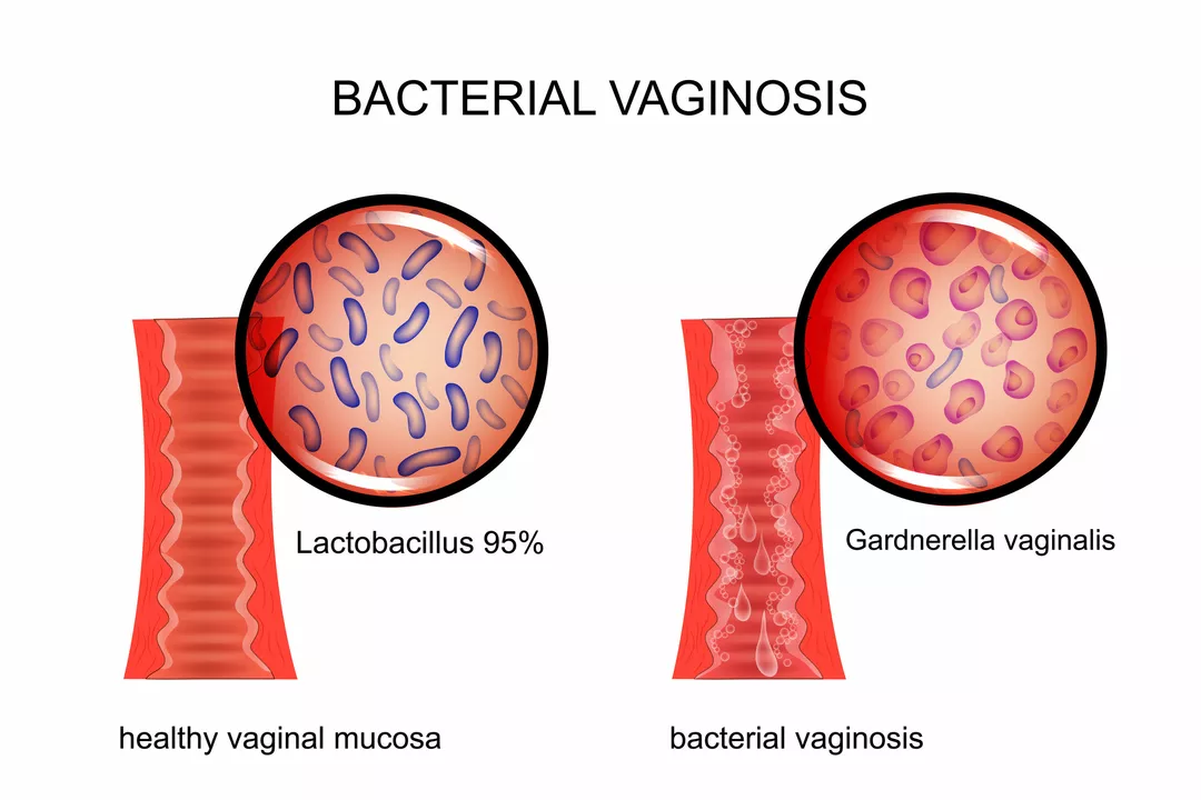 How to Prevent Bacterial Vaginosis: Tips for Maintaining a Healthy Vagina